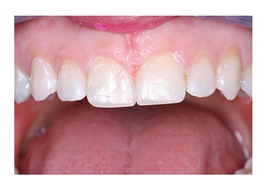 Bonding Close To Diastema