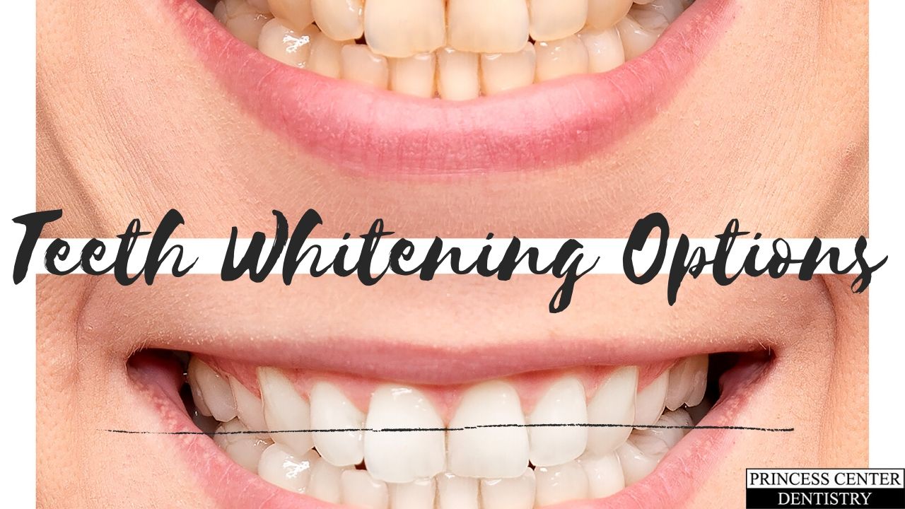 Before and After Picture of Teeth Whitening