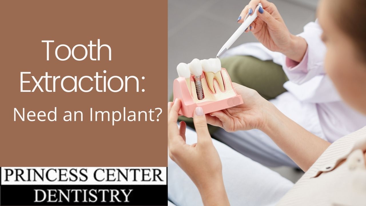 Tooth Extracted: Need an Implant?