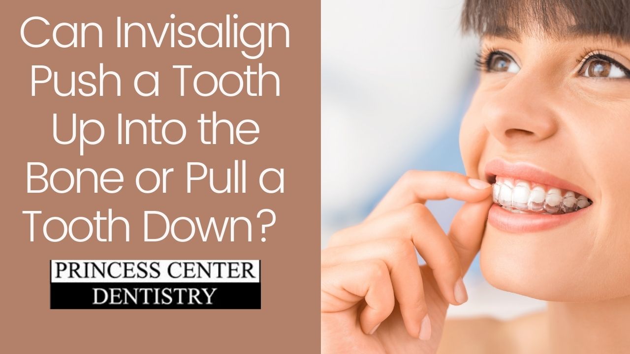 Can Invisalign push a tooth up into the bone or pull a tooth down?